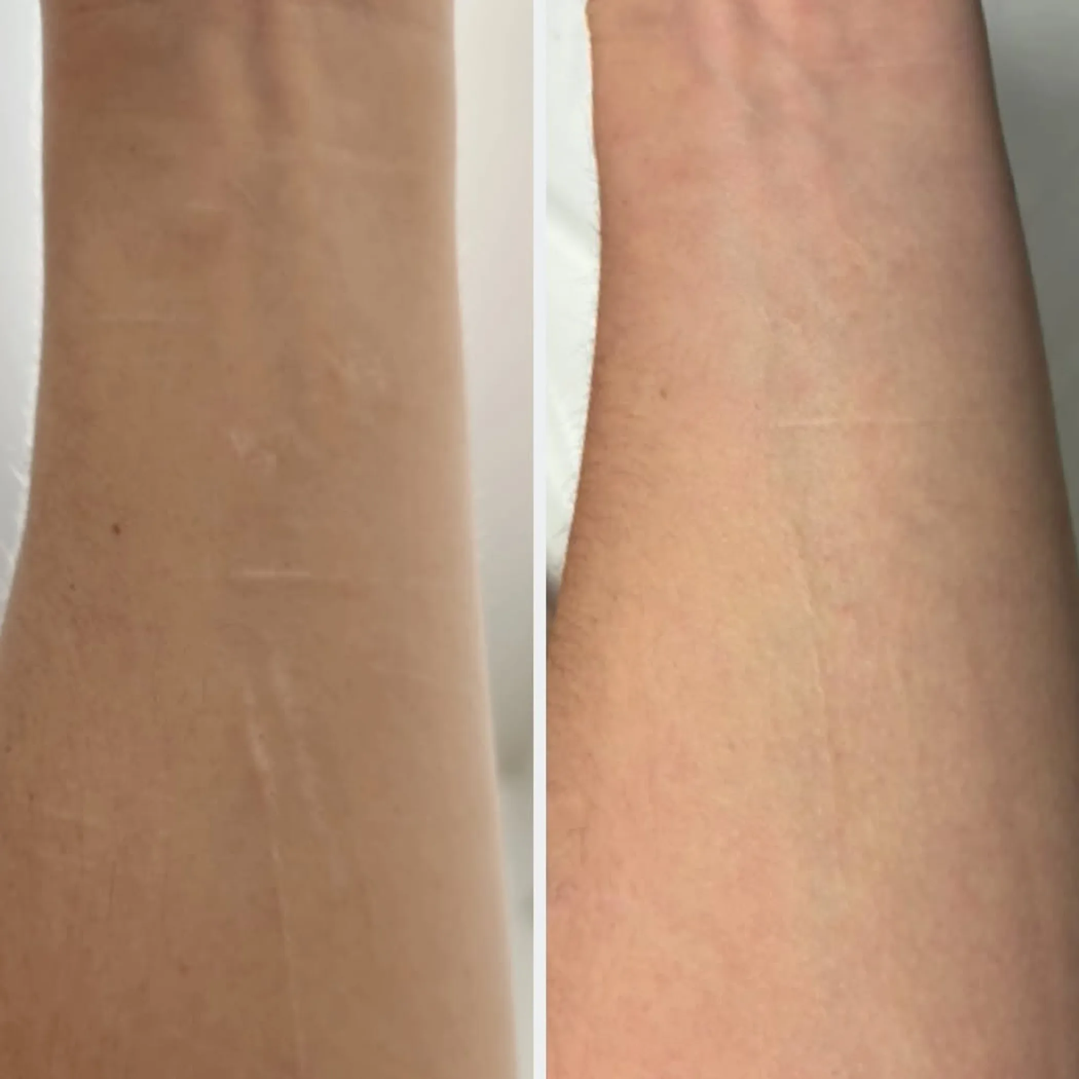 pigment camouflage of a white scar